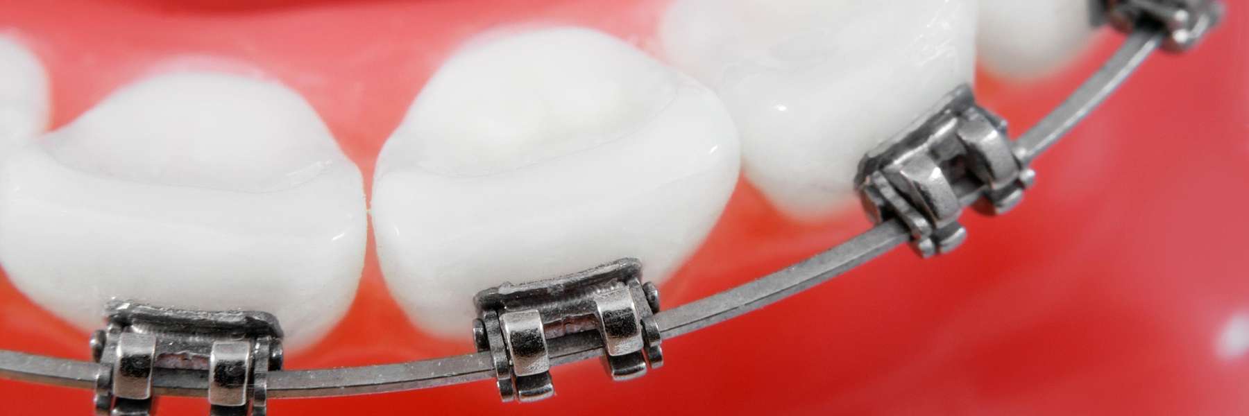 metal braces