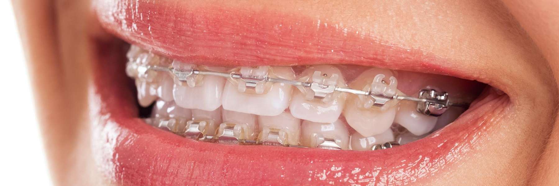 Close up of smiling teeth with braces, Corona CA