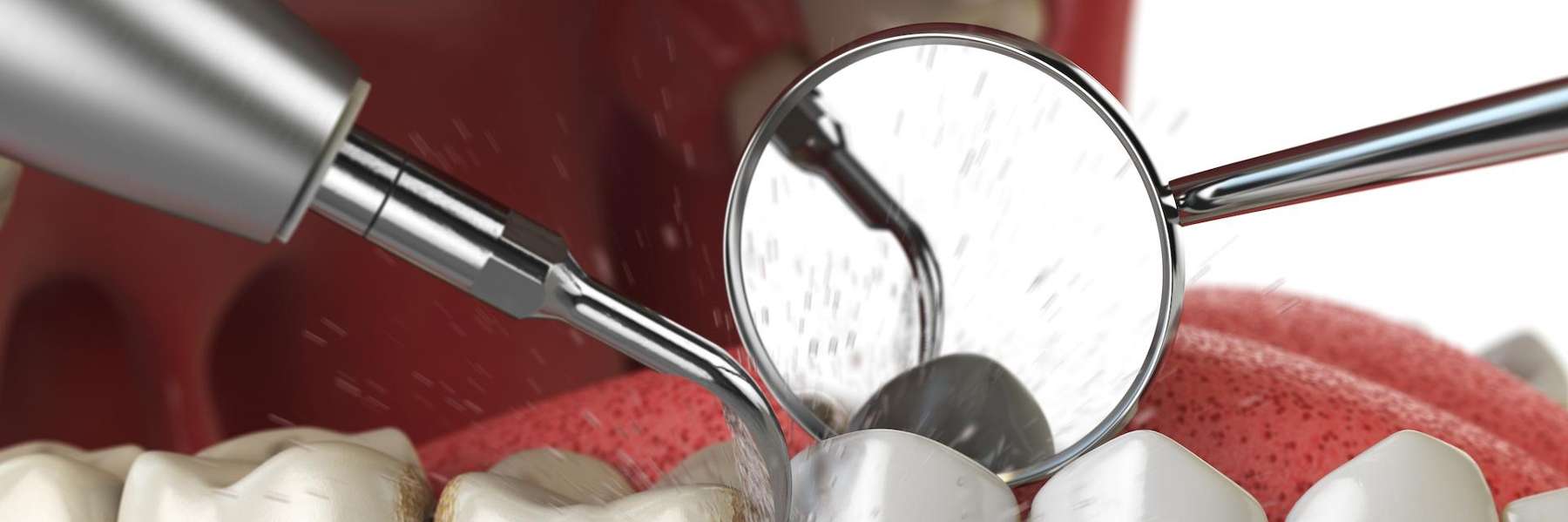 An illustration of a dental cleaning in Corona, CA