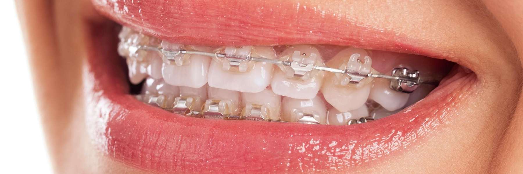smiling girl with braces