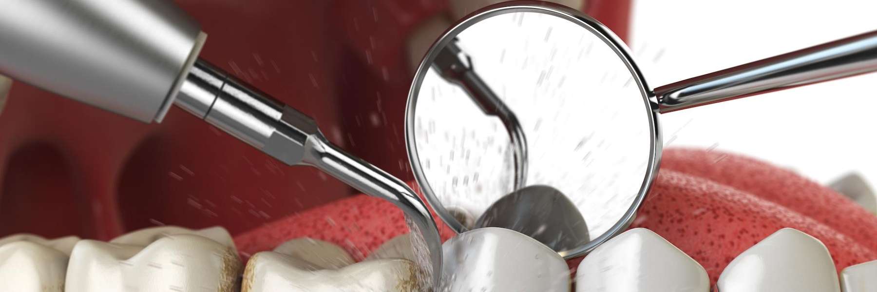 An illustration of a dental cleaning in Corona 