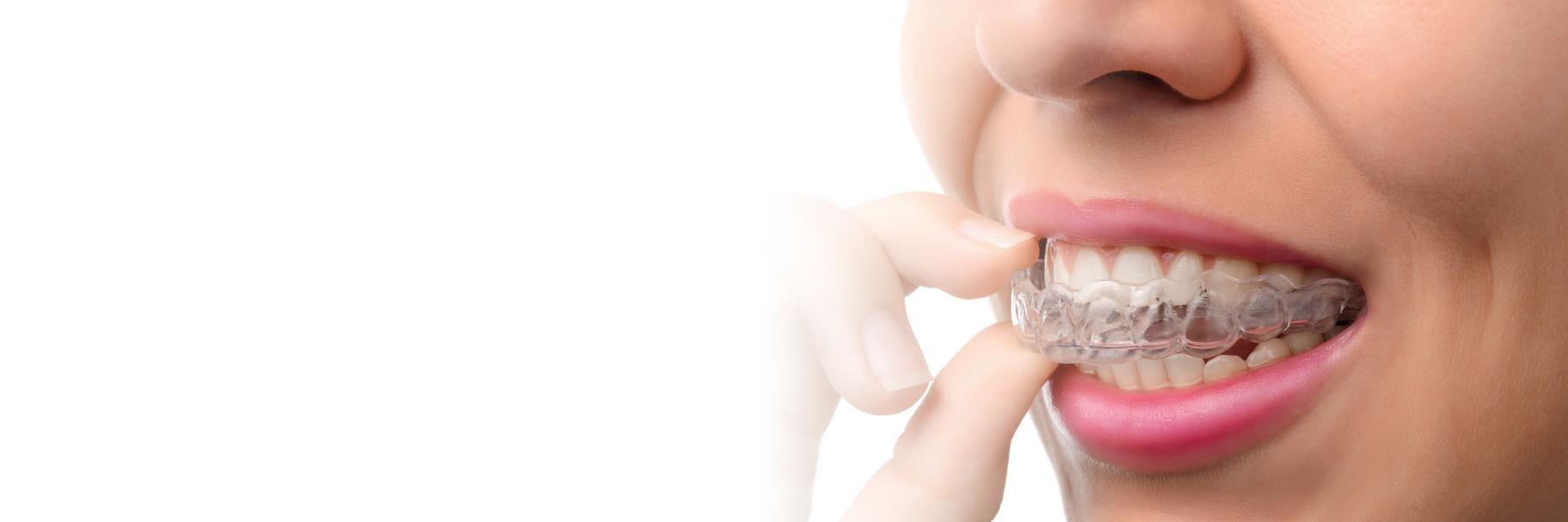 Women taking out invisalign aligners, Corona CA